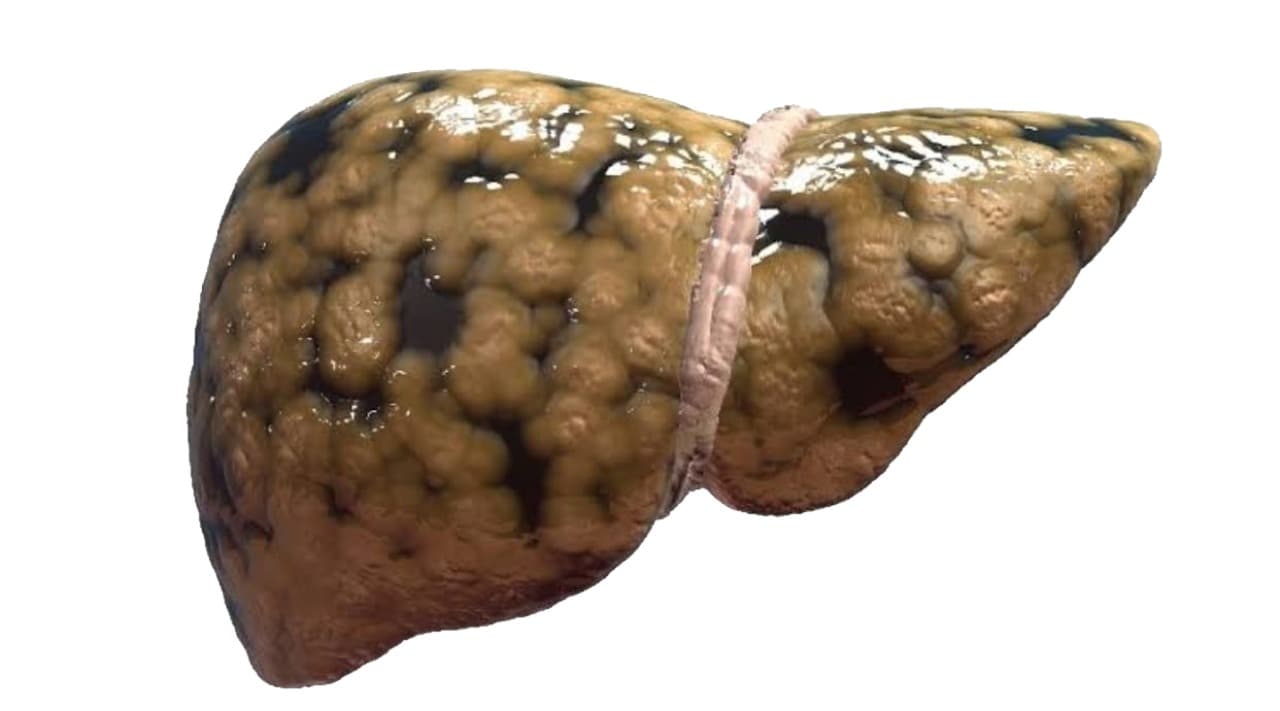 Bahaya Fatty Liver: Waspadai Sebelum Terlambat